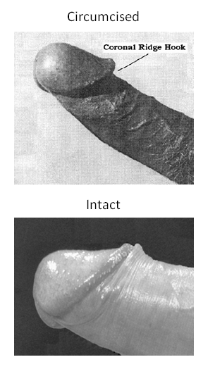Obřezal vs neporušeném stavu penisu